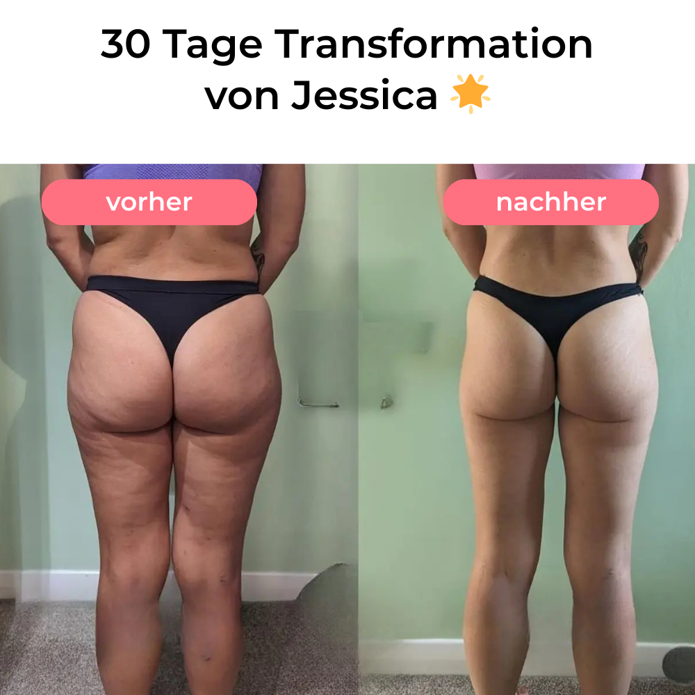 Steinsee Cellulite-Massage Pro